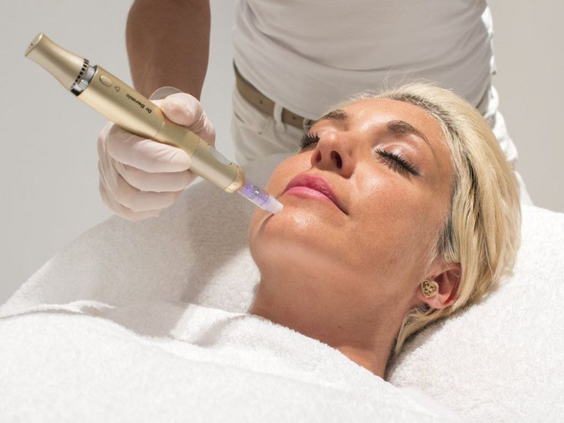 Microneedling