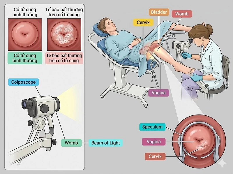 Khi nào cần soi cổ tử cung