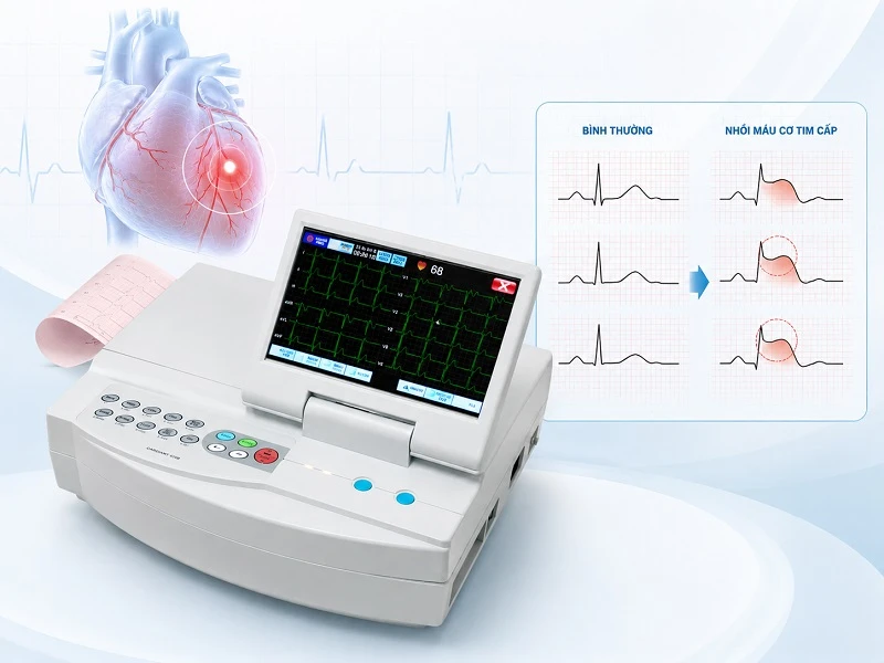 Máy điện tim ghi nhận biến đổi điện tâm đồ trong nhồi máu cơ tim