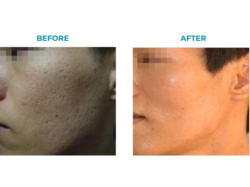 Máy laser CO2 điều trị sẹo rỗ bằng công nghệ vi phân